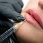 acido hialuronico en labios